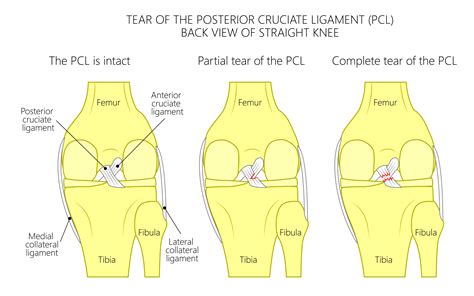 acl and pcl tear test|full thickness tear of pcl.